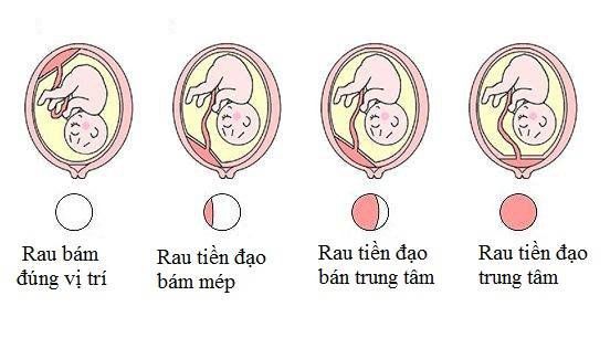 Chẩn Đoán Rau Tiền Đạo: Triệu Chứng, Phương Pháp và Điều Trị