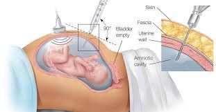 Timing of amniocentesis and chorionic villus biopsies in prenatal diagnosis