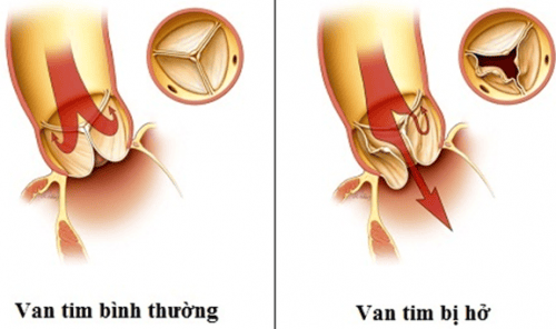 
Hở van tim 3 lá
