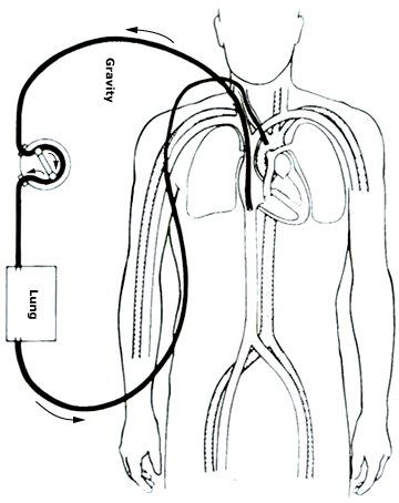 Extracorporeal membrane oxygenation (ECMO)