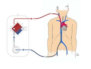 
Phương pháp V-V ECMO
