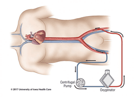 
Phương pháp V-A ECMO
