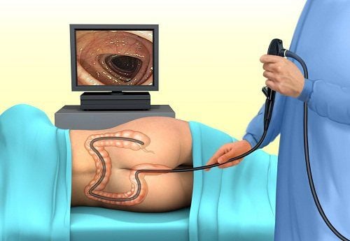 Should a colonoscopy be performed normally or under general anesthesia?