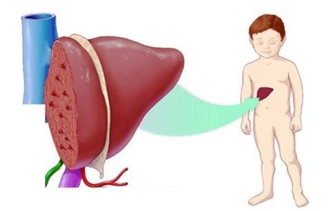 Nutrition after treatment for congenital biliary atresia