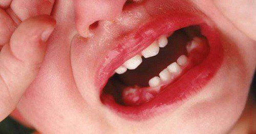 Trẻ 15 tháng bị viêm nướu răng nên làm gì và cần kiêng ăn gì?