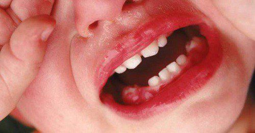 Dangerous complications of gingivitis