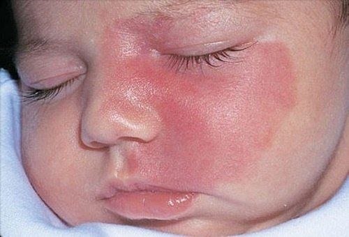 Treatment of hemangiomas in children