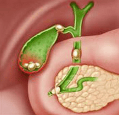 Laparoscopic surgery to open the common bile duct to remove stones