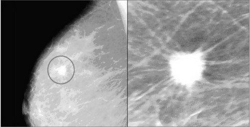 Breast calcification on mammography