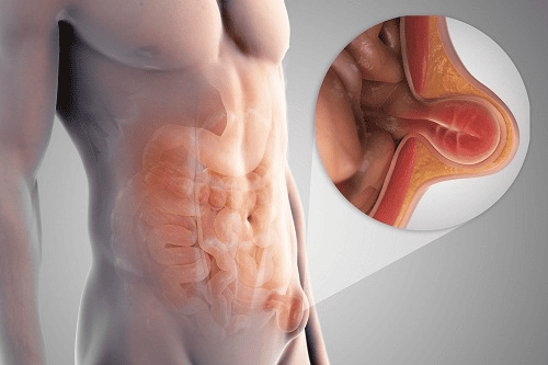 Symptoms of femoral hernia