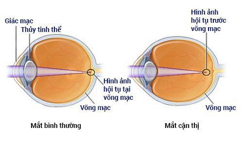 
Bầu thủy tinh tật viễn thị
