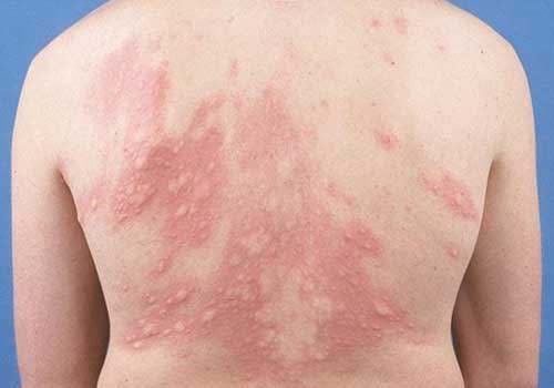 Diagnosis and treatment of urticaria