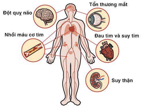 
Tăng huyết áp vô căn gây ra các biến chứng nguy hiểm tới tính mạng
