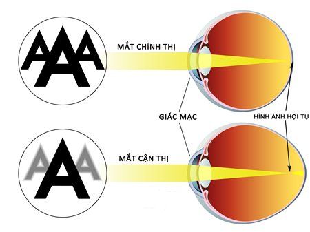 
Ngày nay, cận thị là một trong các tật khúc xạ phổ biến nhất
