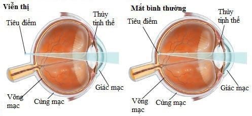 
Viễn thị là tình trạng khi mắt không thể nhìn rõ các vật ở gần
