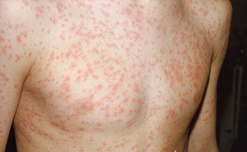 Kháng thể Rubella là gì? Tìm Hiểu Chi Tiết về Kháng Thể và Tác Dụng của Nó