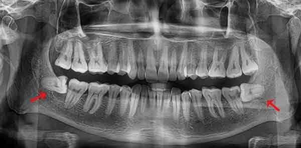 Why do you need an X-ray of your wisdom teeth? | Vinmec