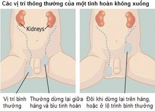 
Các khối u tế bào mầm ở nam giới có thể phát triển tại một số bộ phận khác của cơ thể
