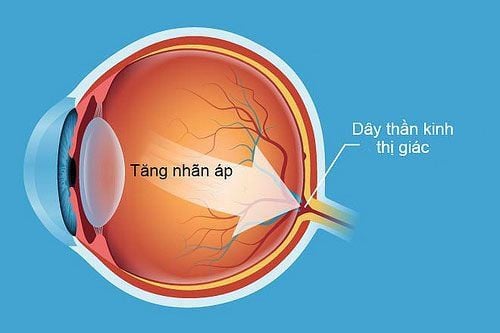 Hướng dẫn trực quan về bệnh tăng nhãn áp