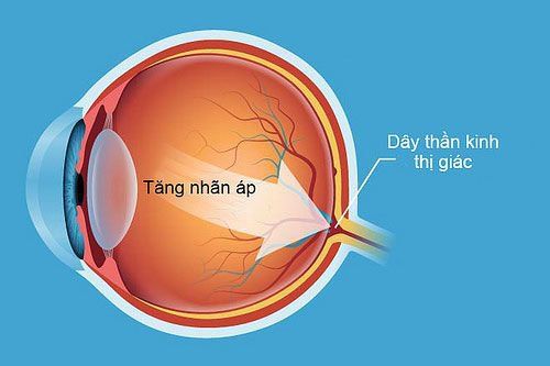 
Bệnh tăng nhãn áp là một phần nguyên nhân dẫn đến đau đầu
