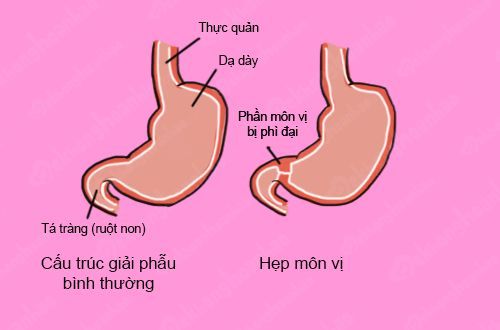 
Hẹp môn vị
