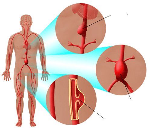 
Những người hút thuốc lá có nguy cơ cao hình thành các mảng xơ vữa động mạch ở động mạch chủ
