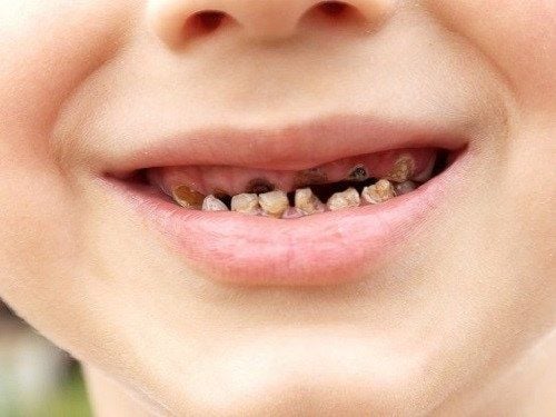 Trẻ bị sâu răng ăn mòn đến lợi có nên nhổ hay không?