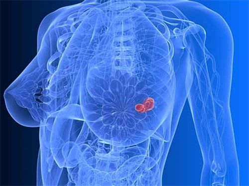 Treatment of metastatic breast cancer