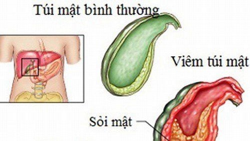 Treatment of cholecystitis with laparoscopic surgery