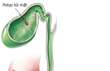 Điều trị polyp túi mật bằng mổ nội soi cắt túi mật