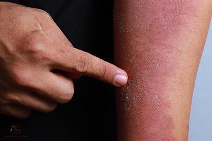 Beware of atopic dermatitis in the dry season