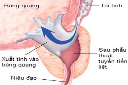 
Xuất tinh ngược ở nam
