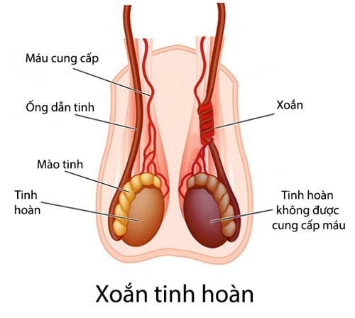 
Xoắn tinh hoàn
