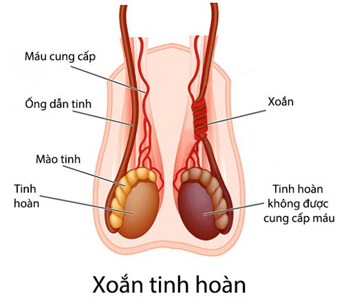 
Hình ảnh xoắn tinh hoàn
