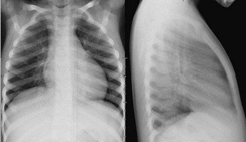 What is a straight chest x-ray? Are there any downsides?