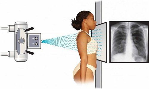 Why do you need to conduct chest x-ray, straight lung?