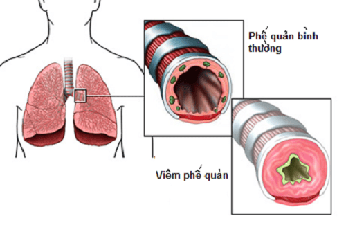 Diagnosis and treatment of acute bronchitis