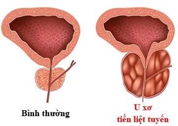 
U xơ tuyến tiền liệt là một nguyên nhân gây tiểu rắt ở nam giới
