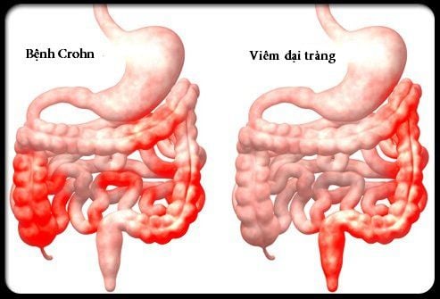 
Nhiều người thường bị nhầm lẫn giữa bệnh Crohn và viêm đại tràng
