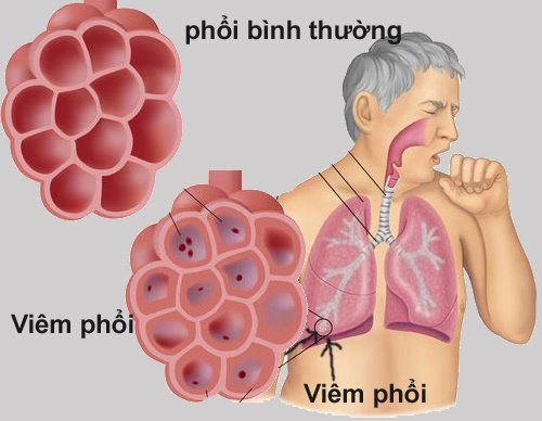 Diagnosis and treatment of hospital-acquired pneumonia