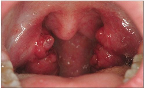 
Polyp amidan là khối u lành tính ở vòm họng
