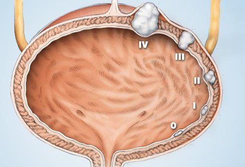 Developmental stages of bladder cancer