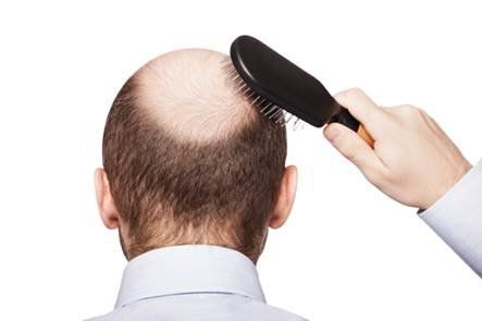 How to prevent baldness?