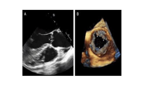 What do 4D ultrasound results show with 6mm bilateral ventricles?