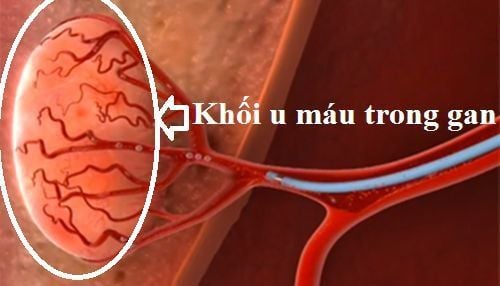 
U máu trong gan là khối u lành tính hay gặp nhất của gan
