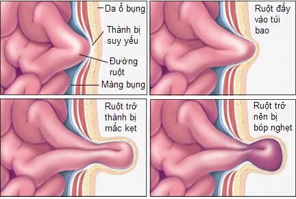 
Thoát vị bẹn nghẹt
