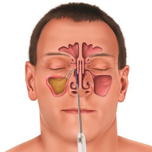 Khi nào cần phẫu thuật nội soi mũi xoang?