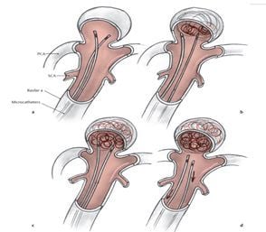 
Hình 2. Nút túi phình bằng kỹ thuật 2 vi ống thông
