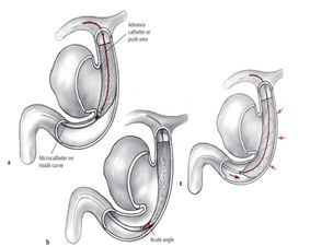 
Hình 3. Nút túi phình bằng phương pháp Stent + Coil
