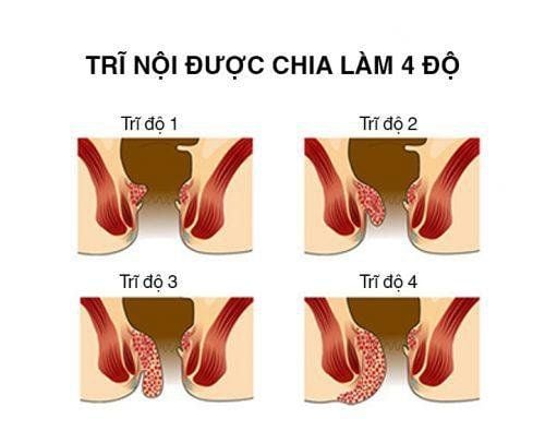 
Các mức độ trĩ nội
